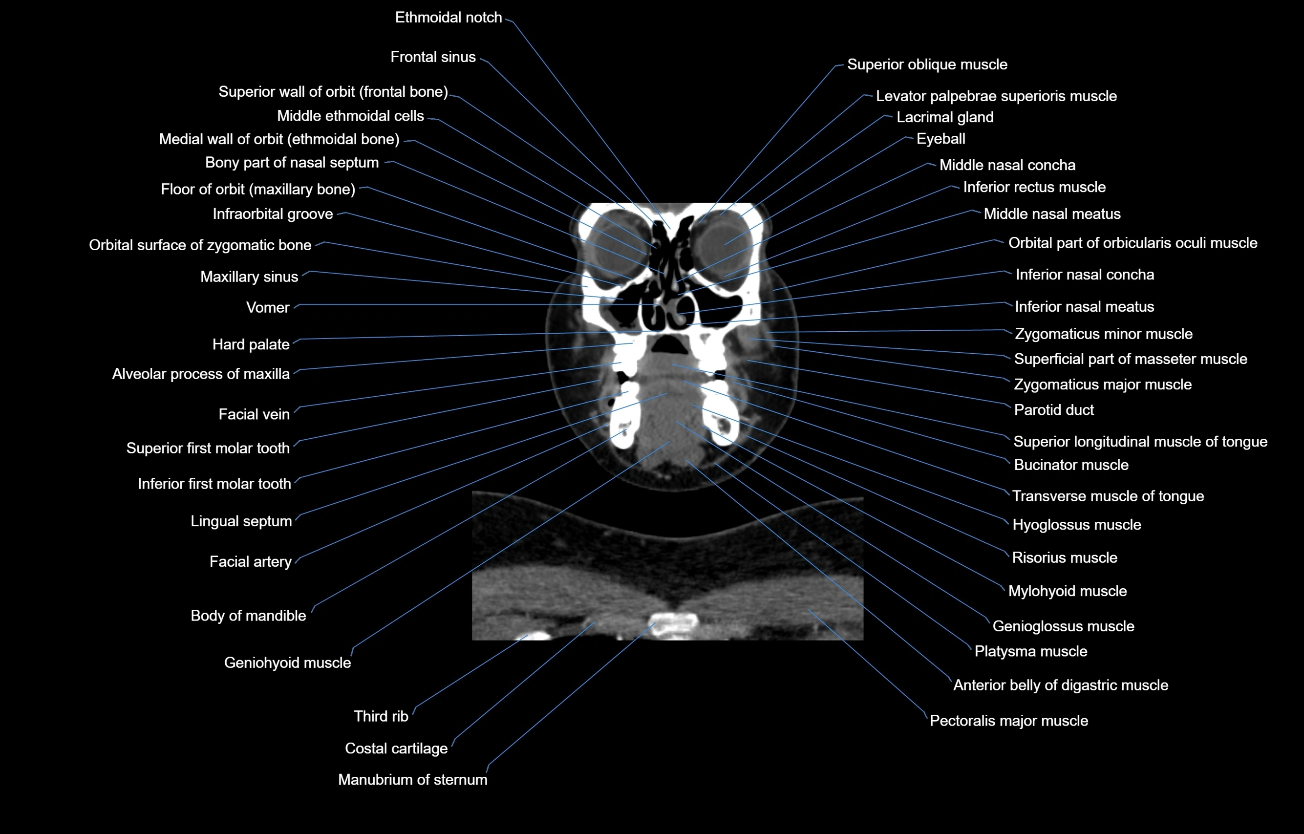 CT Neck coronal  cross sectional anatomy labelled 3D  radiology  image-00016.webp